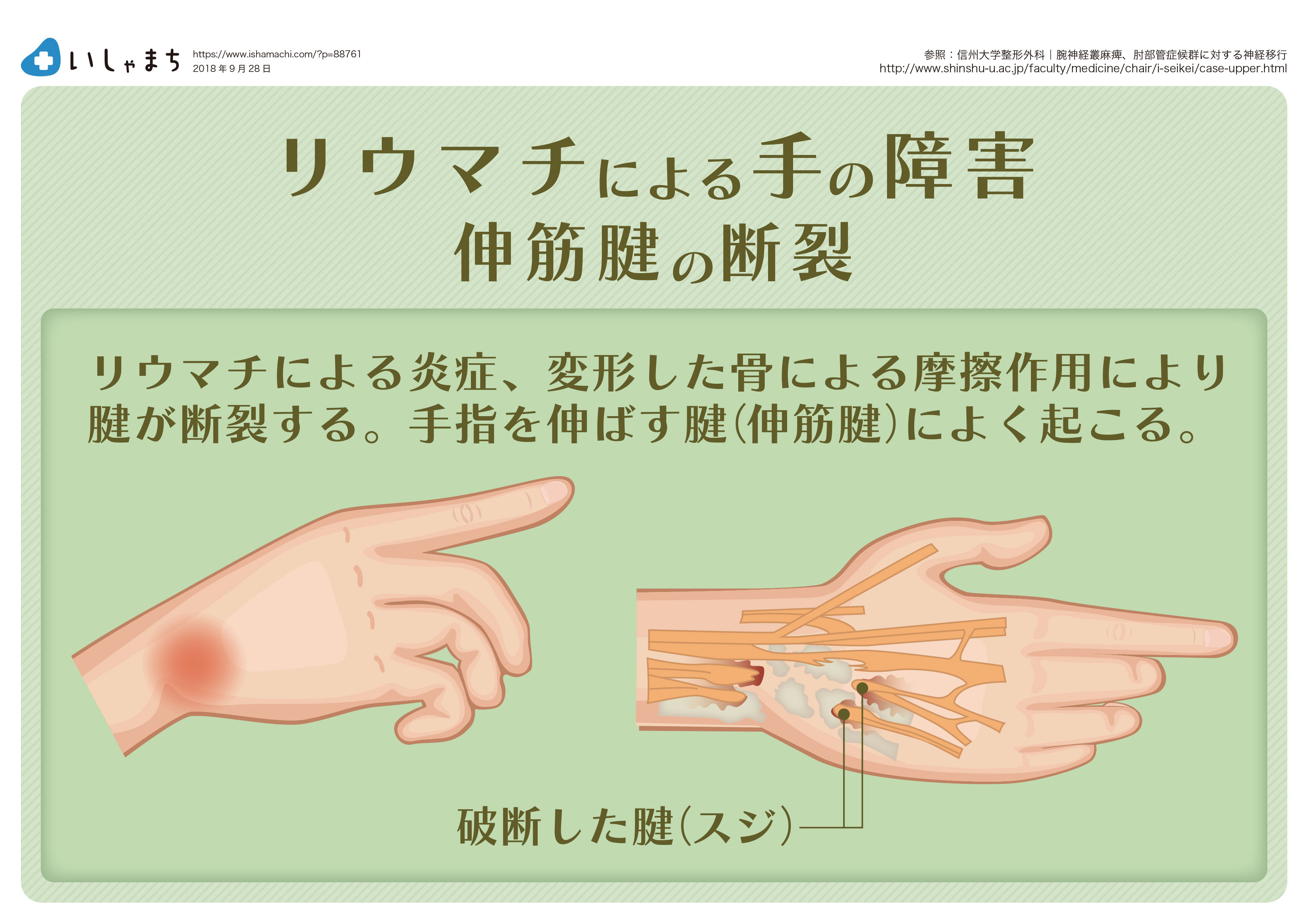 肘の関節リウマチの症状