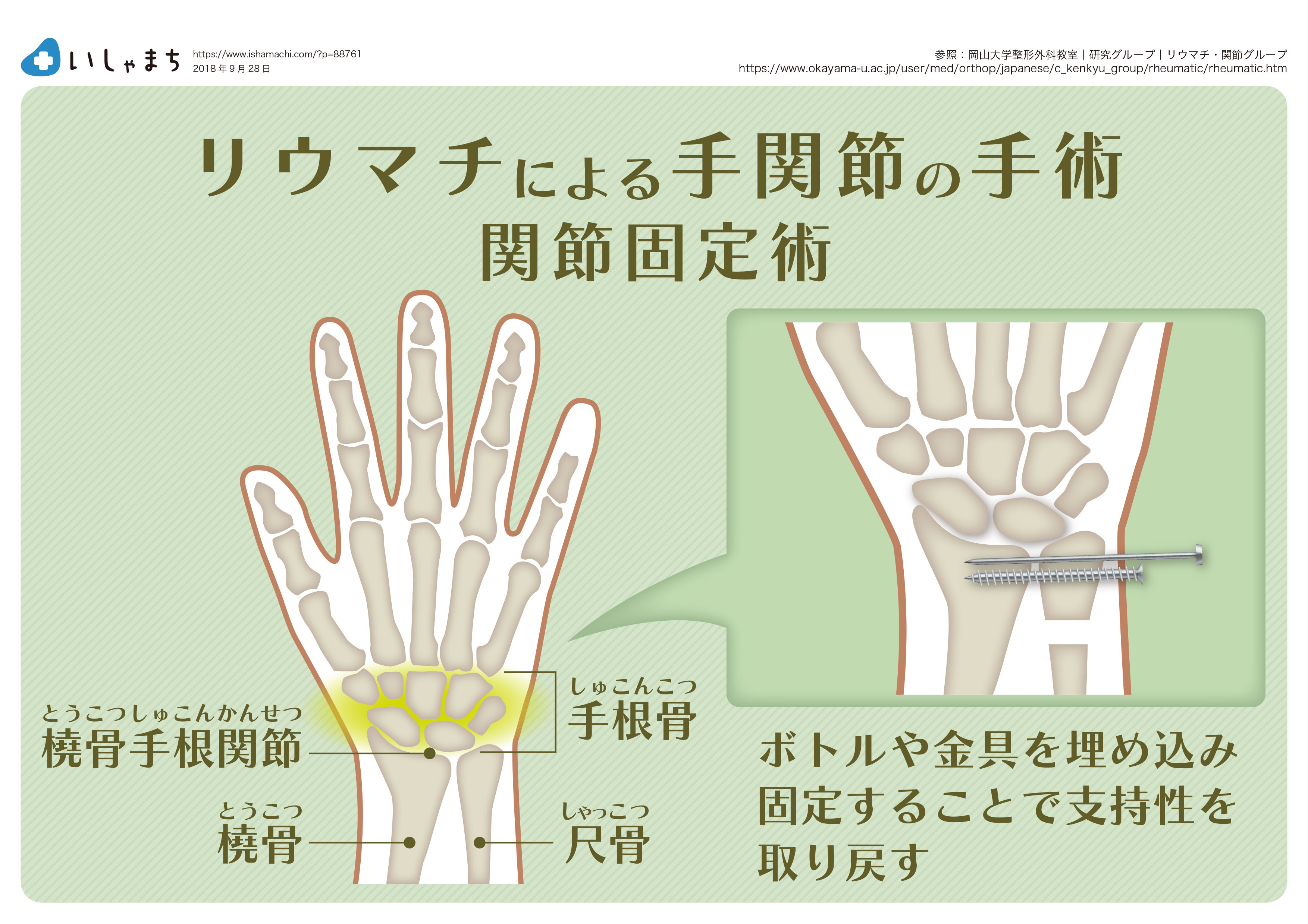 PIP 関節形成術を検討すべきなのは誰ですか?