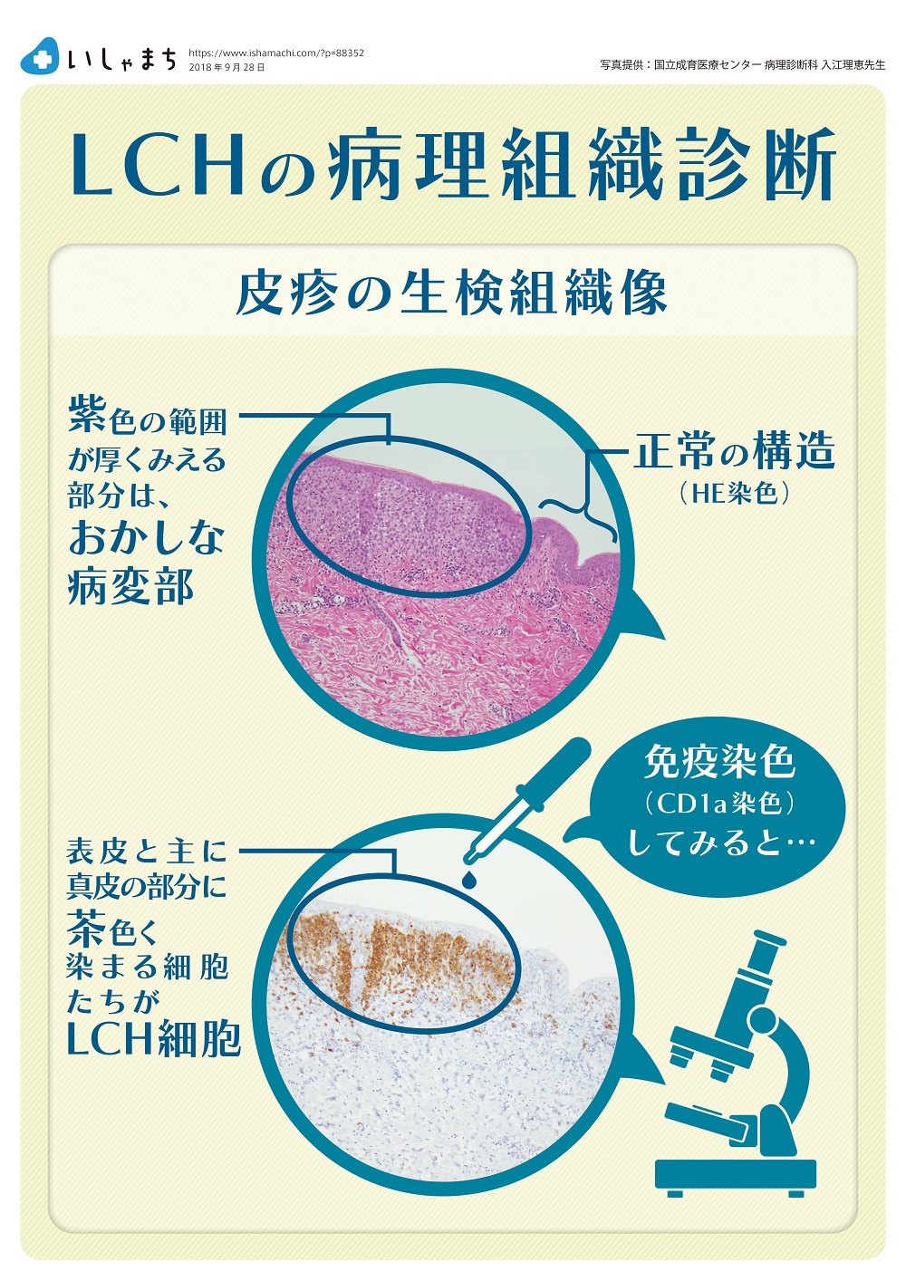 まれな病気 Lch なぜもっとはやく診断できないの いしゃまち
